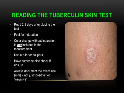 terb ottawa|Tuberculin Skin Test .